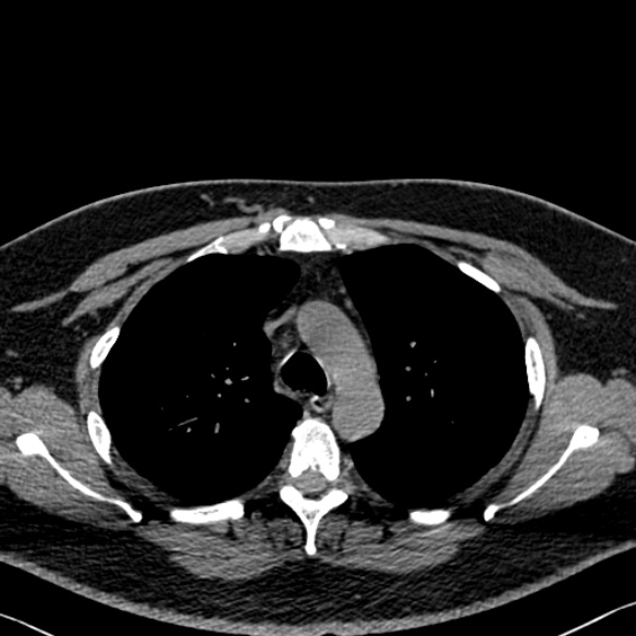 Adenoid cystic carcinoma of the trachea (Radiopaedia 49042-54137 Axial non-contrast 100).jpg