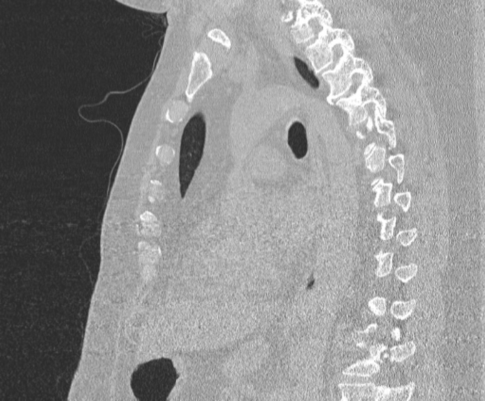 Adenoid cystic carcinoma of the trachea (Radiopaedia 49042-54137 Sagittal lung window 259).jpg