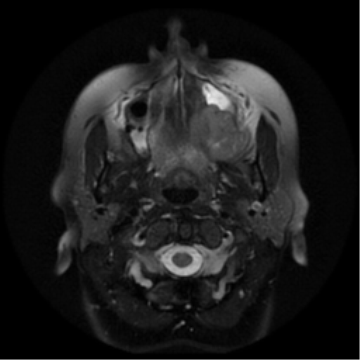 File:Adenoid cystic tumor of palate (Radiopaedia 46980-51519 Axial T2 21).png