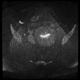 File:Adenomyosis-scar endometriosis (Radiopaedia 65863-75022 Axial DWI 6).jpg