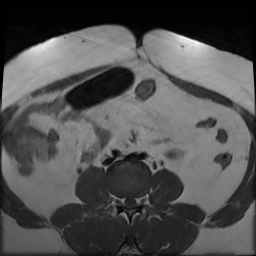 File:Adenomyosis within a didelphys uterus (Radiopaedia 70175-80215 Axial T1 6).jpg
