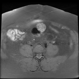 File:Adenomyosis within a didelphys uterus (Radiopaedia 70175-80215 Axial T1 fat sat 12).jpg