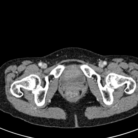 Adhesional small bowel obstruction (Radiopaedia 48397-53305 Axial C+ portal venous phase 93).jpg