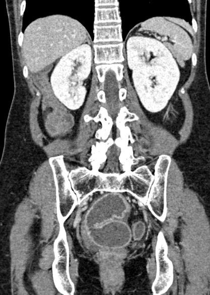 Adhesional small bowel obstruction (Radiopaedia 48397-53305 Coronal C+ portal venous phase 250).jpg