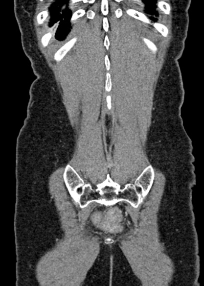 Adhesional small bowel obstruction (Radiopaedia 48397-53305 Coronal C+ portal venous phase 312).jpg