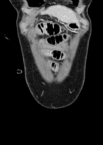 Adhesional small bowel obstruction (Radiopaedia 48397-53305 Coronal C+ portal venous phase 44).jpg