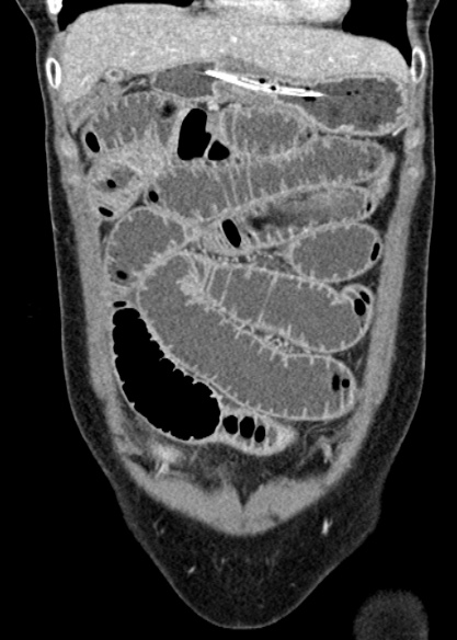 File:Adhesional small bowel obstruction (Radiopaedia 48397-53305 Coronal C+ portal venous phase 88).jpg