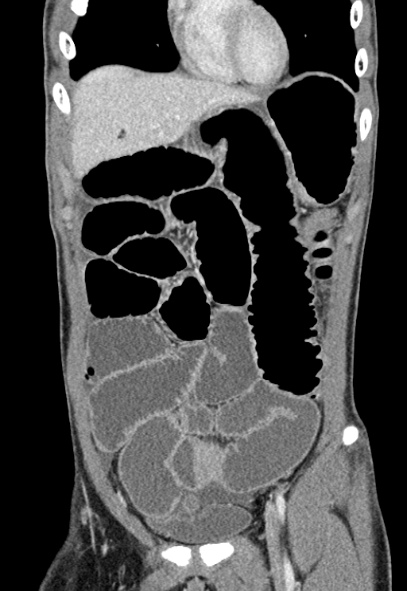 Adhesional small bowel obstruction (Radiopaedia 52107-57980 Coronal C+ portal venous phase 19).jpg