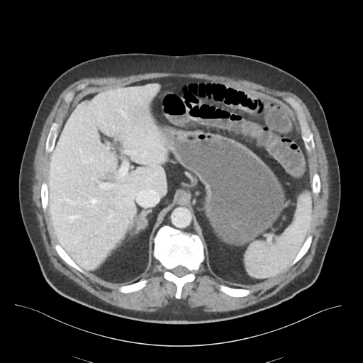 Adhesions within abdominal wall hernia (Radiopaedia 58283-65394 Axial C+ portal venous phase 21).png