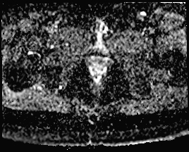 File:Adnexal multilocular cyst (O-RADS US 3. O-RADS MRI 3) (Radiopaedia 87426-103754 Axial 170).jpeg