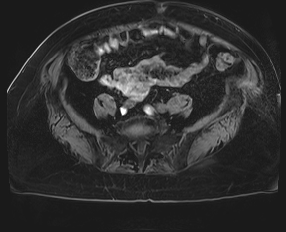 Adrenal cortical carcinoma (Radiopaedia 64017-72770 Axial T1 C+ fat sat 67).jpg