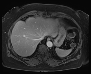 Adrenal cortical carcinoma (Radiopaedia 64017-72770 J 10).jpg