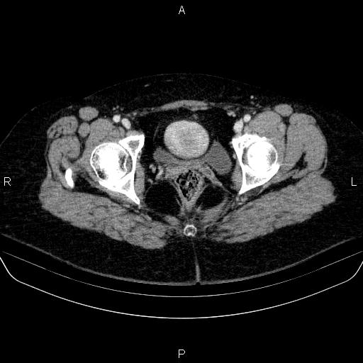 Adrenal cortical carcinoma (Radiopaedia 84882-100379 Axial C+ portal venous phase 92).jpg