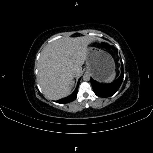 File:Adrenal cortical carcinoma (Radiopaedia 84882-100379 Axial non-contrast 16).jpg