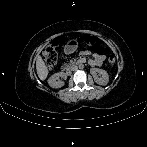 File:Adrenal cortical carcinoma (Radiopaedia 84882-100379 Axial non-contrast 39).jpg