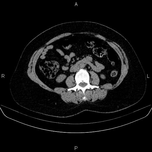File:Adrenal cortical carcinoma (Radiopaedia 84882-100379 Axial non-contrast 47).jpg