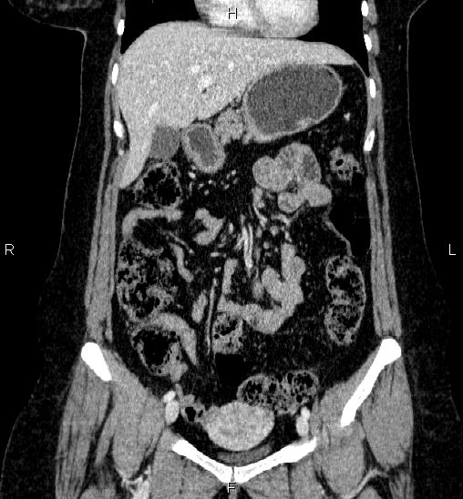 Adrenal cortical carcinoma (Radiopaedia 84882-100379 Coronal C+ portal venous phase 22).jpg
