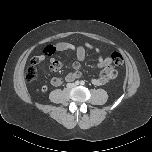 File:Adrenal cyst (Radiopaedia 45625-49777 Axial C+ portal venous phase 63).png