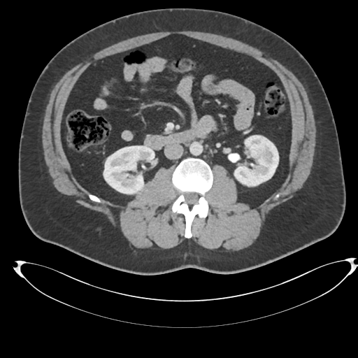 File:Adrenal cyst (Radiopaedia 45625-49778 AXIAL THICK 60 sec 45).png