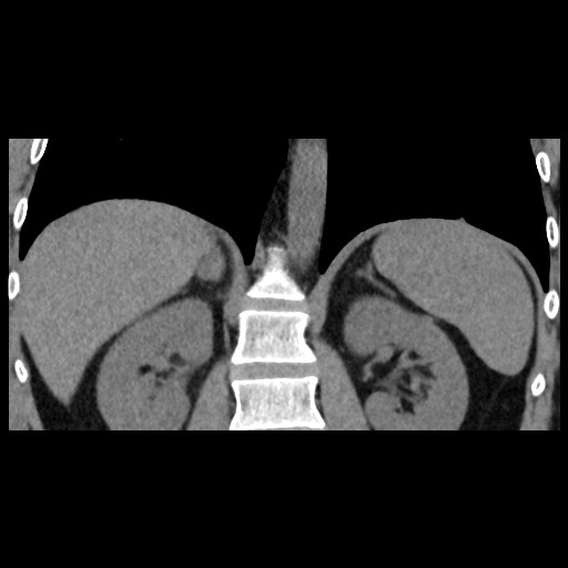 Adrenal gland trauma (Radiopaedia 81351-95079 Coronal non-contrast 58).jpg