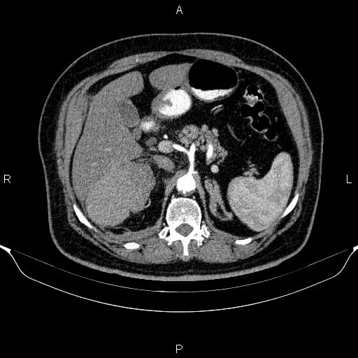 Adrenal hemorrhage (Radiopaedia 62622-70916 Axial C+ arterial phase 116).jpg