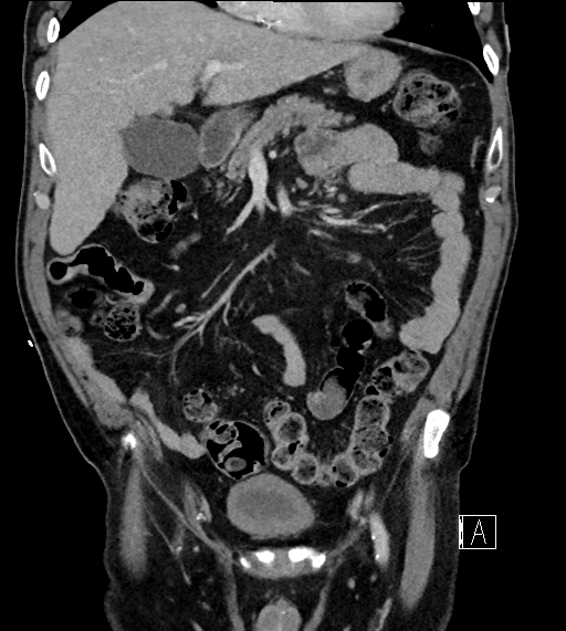 Adrenal lymphoma (Radiopaedia 73730-84529 Coronal C+ portal venous phase 28).jpg