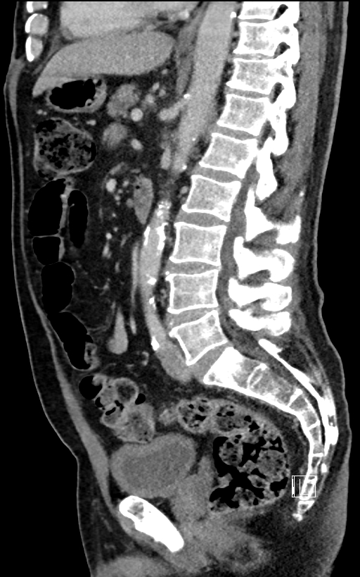 Adrenal lymphoma (Radiopaedia 73730-84529 Sagittal C+ portal venous phase 62).jpg