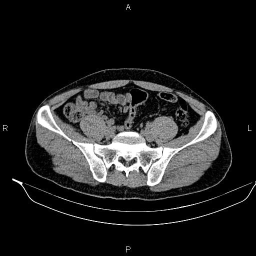 Adrenal myelolipoma (Radiopaedia 87794-104246 Axial non-contrast 79).jpg