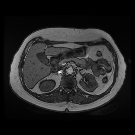 File:Adrenal myelolipoma - MRI (Radiopaedia 83249-97646 T1 out-of-phase 11).jpg