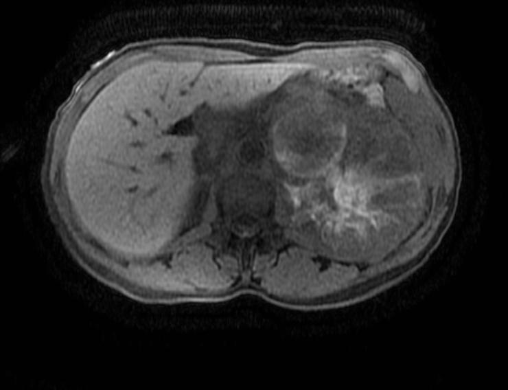 File:Adrenocortical carcinoma (Radiopaedia 11176-11541 Axial 4).jpg