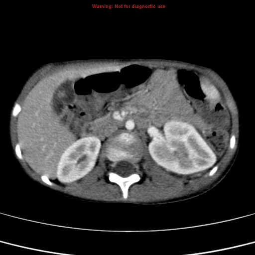 File:Adrenocortical carcinoma (Radiopaedia 9449-10131 Axial C+ portal venous phase 24).jpg