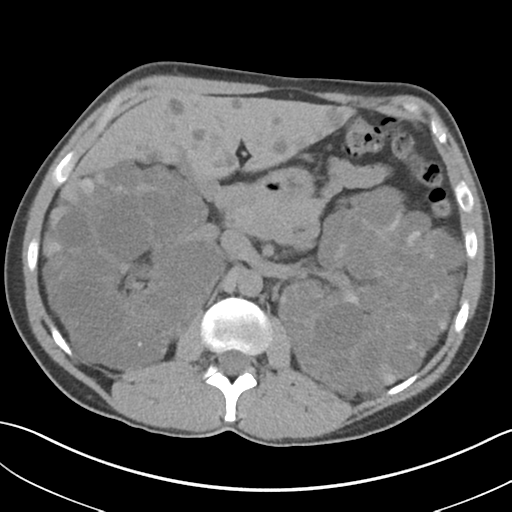 File:Adult polycystic kidney disease (Radiopaedia 47866-52626 Axial non-contrast 28).png
