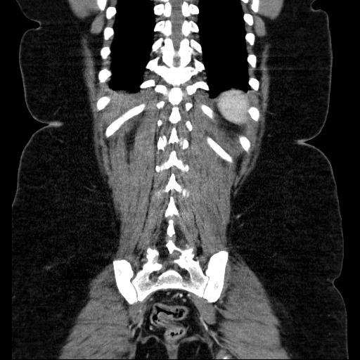 File:Afferent loop syndrome - secondary to incarcerated trocar site hernia (Radiopaedia 82959-97305 Coronal C+ portal venous phase 118).jpg