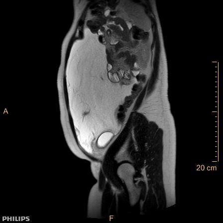 Aggressive angiomyxoma (Radiopaedia 73343-84093 Sagittal T2 44).jpg
