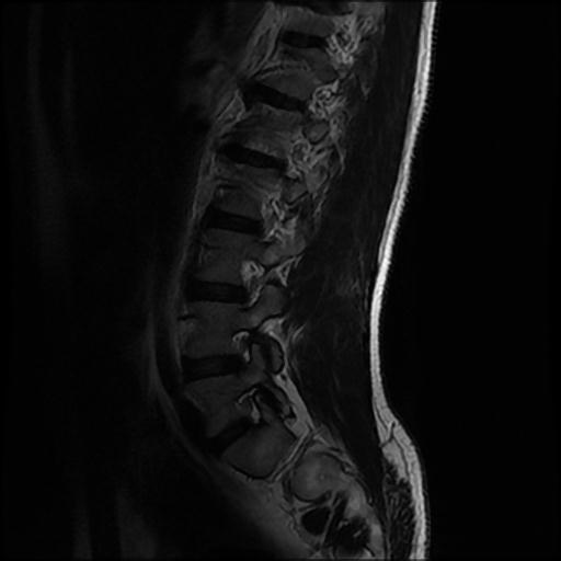 File:Aggressive vertebral hemangioma with pathological fracture (Radiopaedia 69528-79411 Sagittal T2 9).jpg