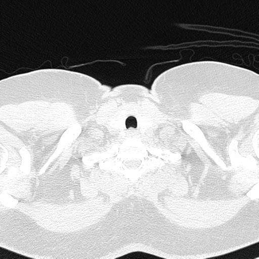 File:Air trapping in small airway disease (Radiopaedia 61685-69694 Axial lung window 1).jpg