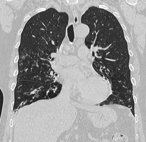 Alpha-1-antitrypsin deficiency (Radiopaedia 72058-82557 Coronal lung window 36).jpg