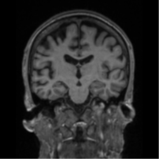 File:Alzheimer's disease- with apraxia (Radiopaedia 54763-61011 Coronal T1 48).png