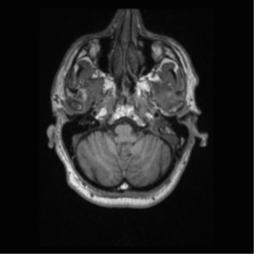 Alzheimer disease - probable (Radiopaedia 35334-36837 Axial T1 17).png