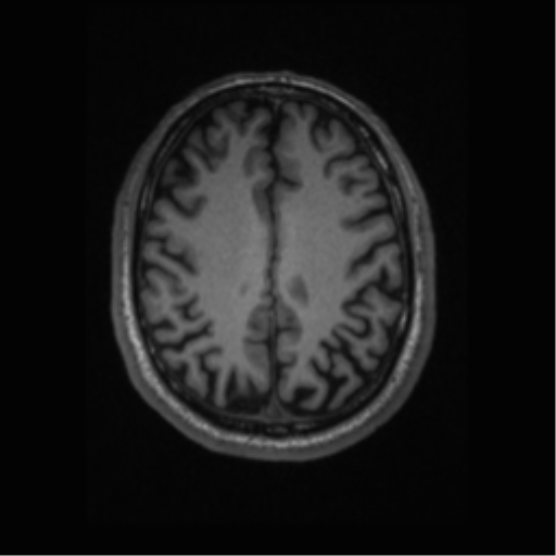File:Alzheimer disease - probable (Radiopaedia 35334-36837 Axial T1 52).png