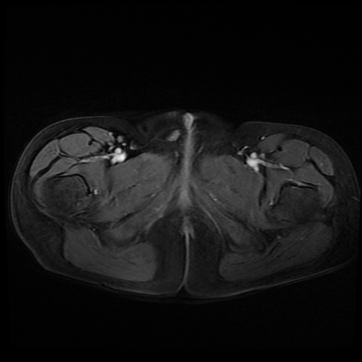 Ambiguous genitalia (Radiopaedia 69686-79643 Axial T1 C+ fat sat 52).jpg