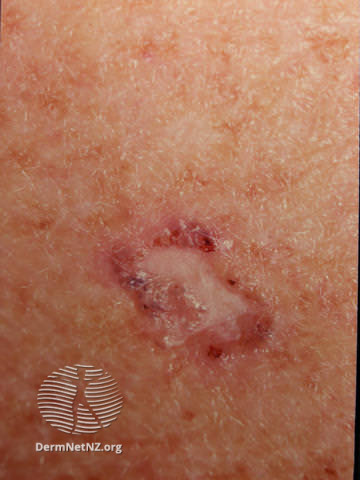 File:Amelanotic melanoma (DermNet NZ amelanotic-melanoma-017).jpg