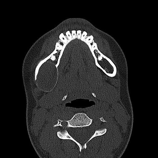 File:Ameloblastoma (Radiopaedia 26645-26793 E 23).jpg