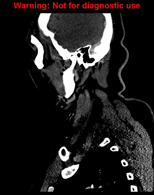 Ameloblastoma (Radiopaedia 33126-34164 F 54).jpg