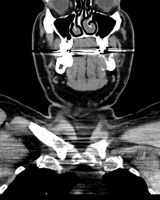 Ameloblastoma (Radiopaedia 38520-40623 Coronal non-contrast 25).png