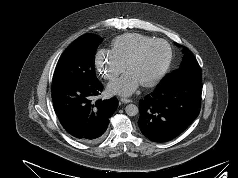 Amiodarone lung (Radiopaedia 62514-70769 Axial non-contrast 58).jpg