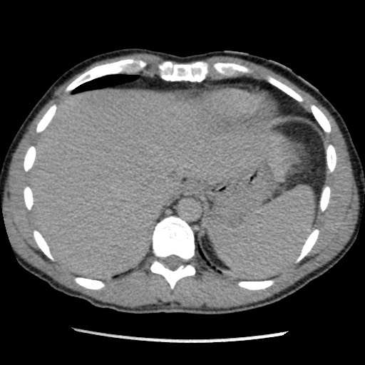Amoebic liver abscesses (Radiopaedia 55536-62009 Axial C+ delayed 15).jpg