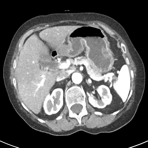 Ampullary adenocarcinoma (Radiopaedia 34013-35237 B 26).png