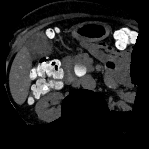 Ampullary adenocarcinoma (Radiopaedia 34013-35241 AXIAL MIPS 3-1.5 67).png