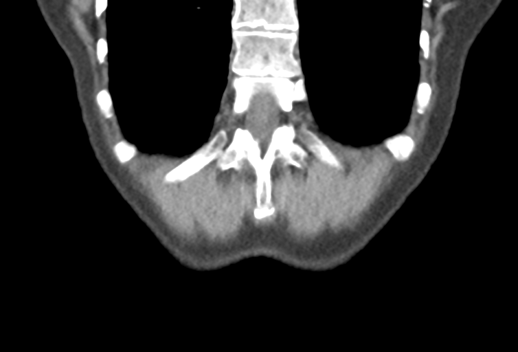 Ampullary adenocarcinoma (Radiopaedia 34013-35241 Coronal 48).png
